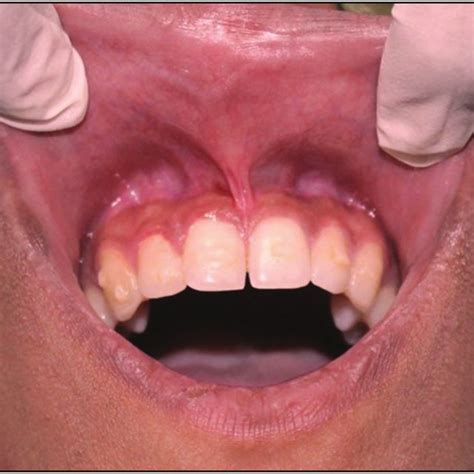 Pdf Diode Laser Frenectomy A Case Report With Review Of Literature