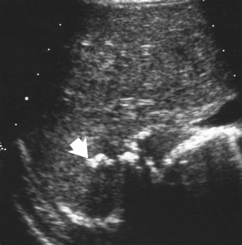 Infantile Hepatic Hemangiomas Clinical And Imaging Findings And Their