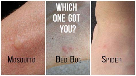 Spider Bites Vs Bed Bug Bites What S The Difference Pest Wiki Bed Bug Bites Bed Bugs