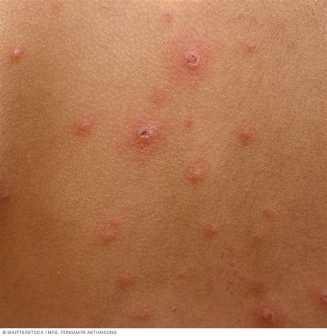 Chickenpox Disease Reference Guide