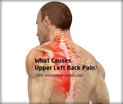 What Causes Upper Left Back Pain Alternative Medicine Pinterest