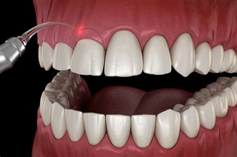 Gingival Sculpting Reshape The Gum Tissue Around Your Teeth