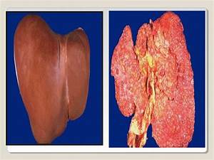 Cirrhosis of liver.2003 all Cirrhosis  
