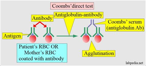 Hemolytic Anemia Of Newborn Hdn And Coombs Test