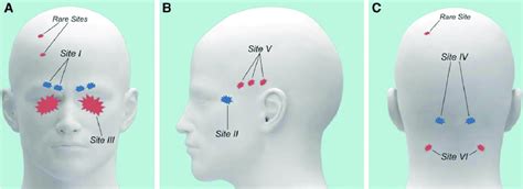 Anatomy Of Common And Rare Migraine Triggers Site I Supraorbital And