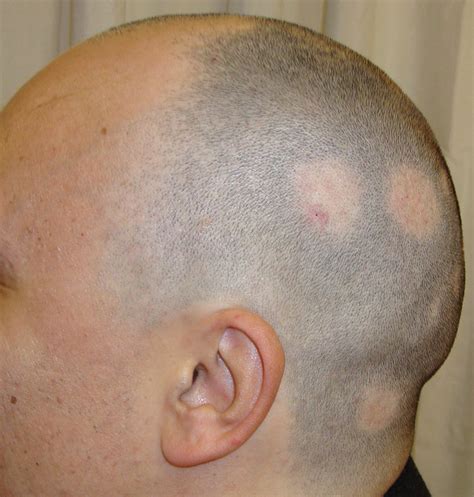 Alopecia Areata Solución Causas Problema Tratamiento Especialista