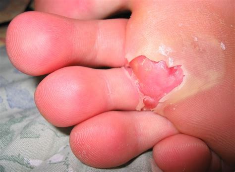 Ampollas En Los Pies ⇒ ↓prevención Y Tratamiento↓