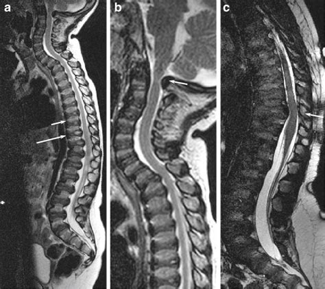 Initial Mri Studies Should Include Screening Of The Whole Spine In A