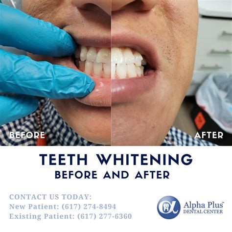 Teeth Whitening Before And After By Brookline Cosmetic Dentist