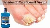 Do Home Remedies Work For Toenail Fungus Images