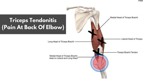 Lifters Elbow Pain Triceps Tendonitis A Helpful Guide