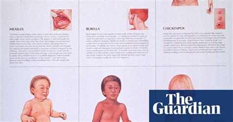 Measles Prevention Posters From Around The World In Pictures
