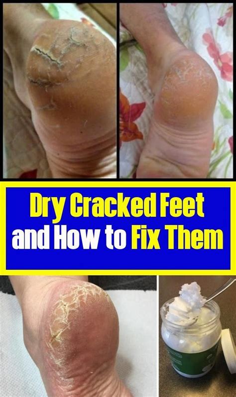 Cracked Dry Feet And How To Fix In 2020 Dry Cracked Feet Cracked