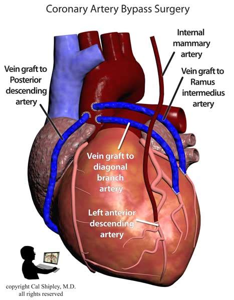 Coronary Artery Bypass Graft Trial Image Inc