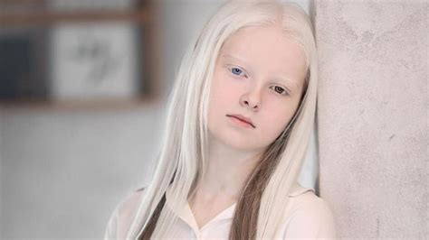 Amina Ependieva Gadis Albino Yang Mempesona Asal Rusia Foto 1
