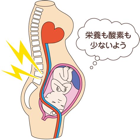 妊娠高血圧症候群 妊娠中～分娩時のゆるみ ゆがみの影響 骨盤ケア（トコちゃんベルトの青葉 公式サイト）