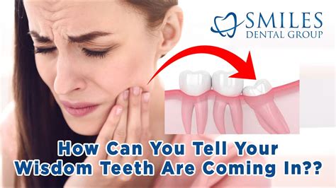 Wisdom Teeth Important Facts 2021 How Can You Tell They Are Coming In What Age To Expect