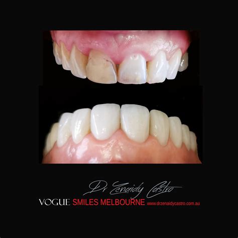 Dental Bonding And Composite Veneers Vogue Smiles