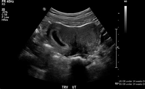 Ultrasound Demonstrating Ud Following Suspected Miscarriage Download