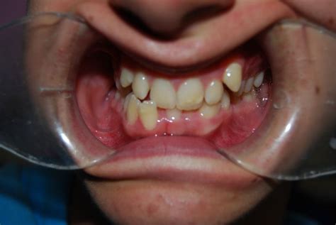 Apiñamiento dental o dientes torcidos BOJ Odontopediatría BCN