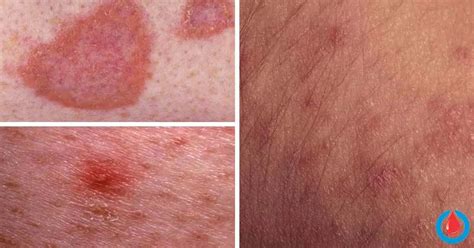 The Most Common Skin Complications Linked To Diabetes Diabetes Health