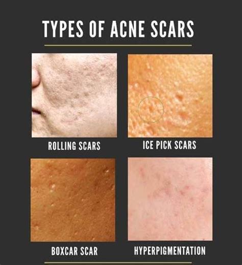 What Causes Acne Scars Acne Scars Treatment