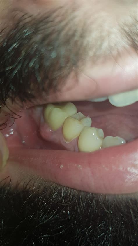 Bump On Gums Under Tooth 4 Tooth Bantuanbpjs