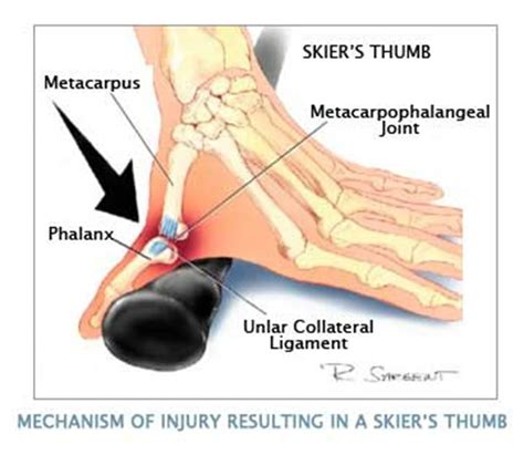 Mri Newsletter Ulnar Collateral Ligament Injury Radius Imaging