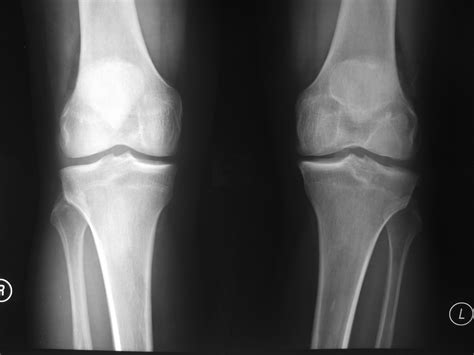 The sample acl includes an owner element that identifies the owner by the aws account's canonical. ACL Tears - What Can Happen If Left Untreated? | HC Chang ...