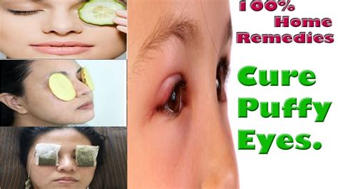How To Cure Puffy Eyes At Home│ Home Remedies How To Get Rid Of Eye Bags Youtube