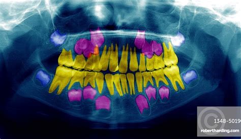 Child Dental X Ray Stock Photo