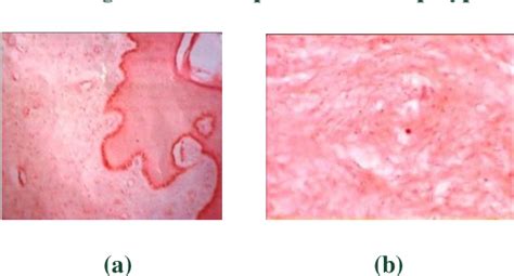 Figure From Recurrent Vulval Fibroepithelial Polyp With Pregnancy A