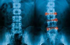 Progression To Clinical Axial Spondyloarthritis Seen In First Degree