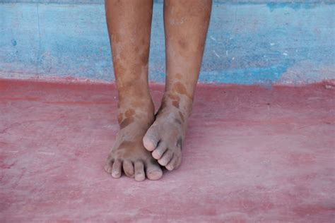 Barefoot Poverty Stock Photos Pictures And Royalty Free Images Istock