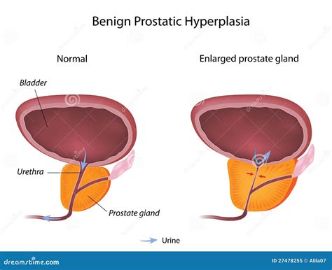 Hiperplazia De Prostata Cauze Simptome Tratament Sfaturimedicale Ro Sexiz Pix