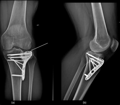Reconstruction Of Tibial Plateau Fracture Malunion In The Se Jbjs