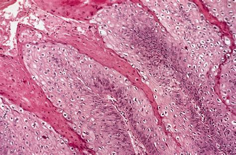 Pathology Outlines Hpv Associated Squamous Cell Carcinoma