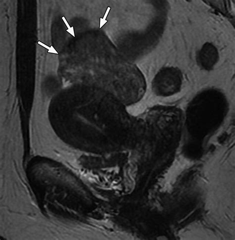 Imaging Features Of Primary And Metastatic Malignant Perivascular