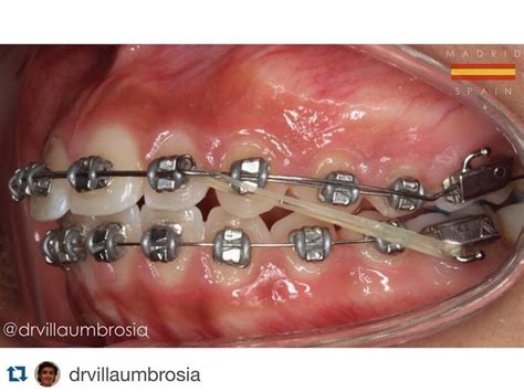 Odontoespacio On Instagram “repost Drvillaumbrosia Tip Edge System