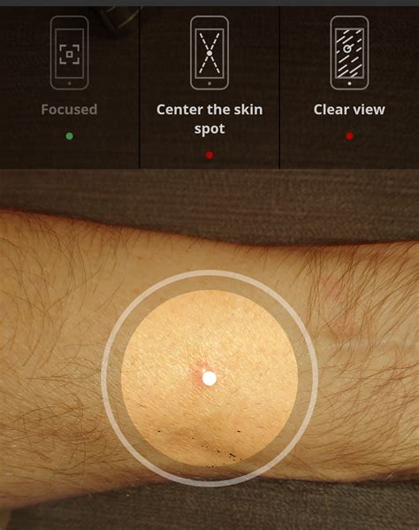 skinvision app review instant spot mole assessment