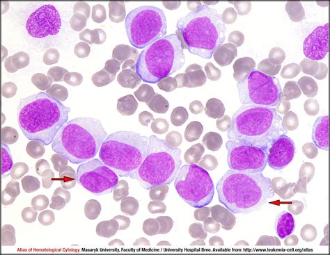 Acute Monoblasticmonocytic Leukaemia Cell Atlas Of Haematological