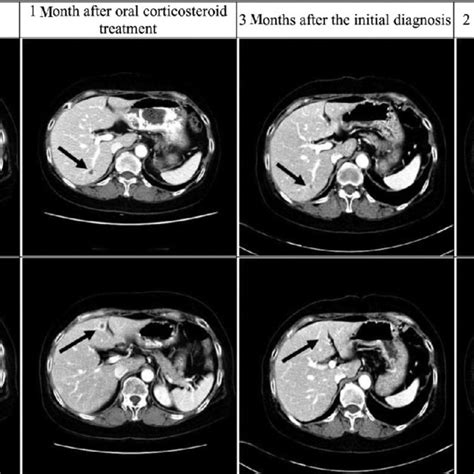 Abdominal Computed Tomography Scans Black Arrows Indicate Lesions With