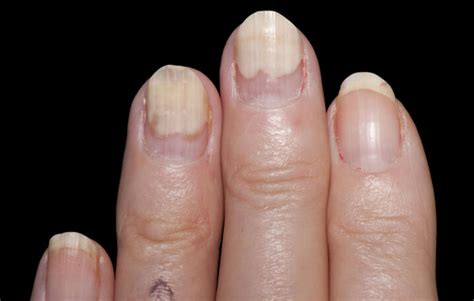 How To Deal With Common Nail Problems Ingrown Nails And