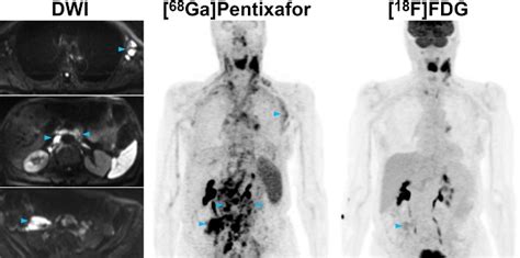 Cxcr4 Pet Imaging Of Mantle Cell Lymphoma Using 68ga Pentixafor