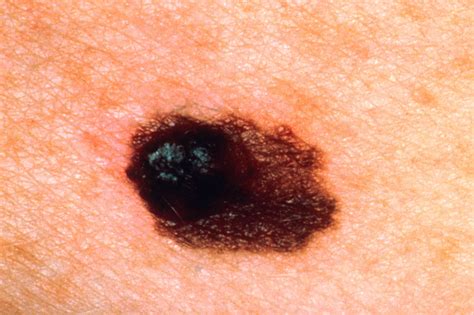 Minority Of Melanomas With Complete Response To Antipd 1 Relapsed