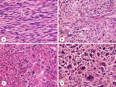 Smooth Muscle Tumors Of Soft Tissue And Non Uterine Viscera Biology