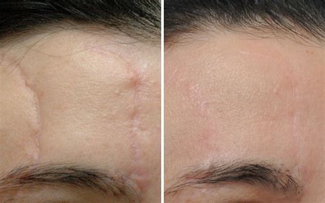 Scar Removal Before After Photos Annapolis Md