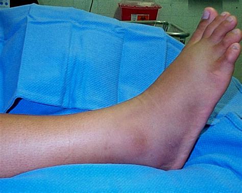 Ankle Fractures Tyler Tx Podiatrist