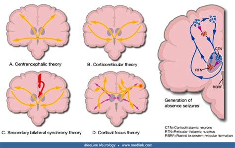 Generalized Onset Tonic Clonic Seizures Medlink Neurology