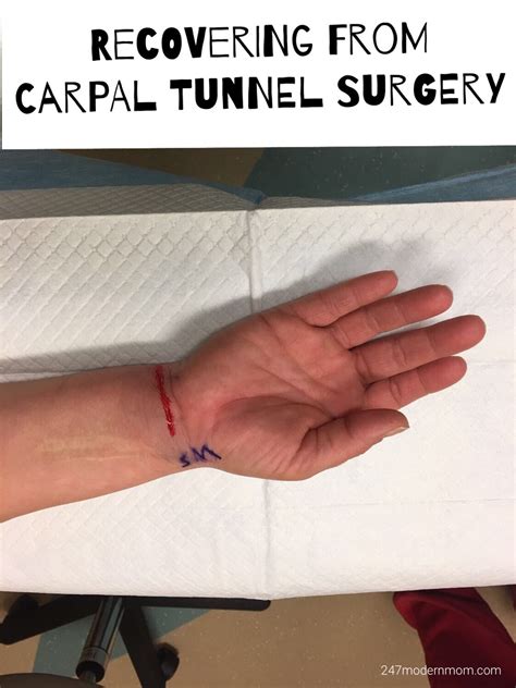 Recovering From Carpal Tunnel Surgery My Journey